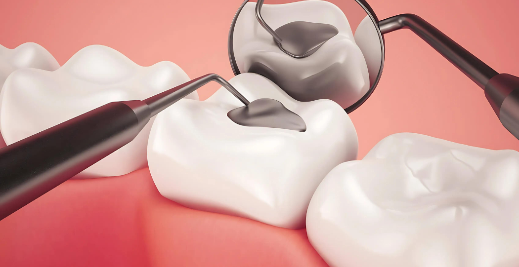 Types of Dental Fillings