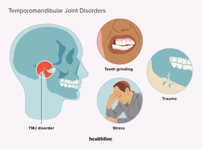 Anatomy of the temporomandibular joint and common TMJ disorder triggers