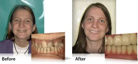 Before and after photos of a patient's orthodontic treatment