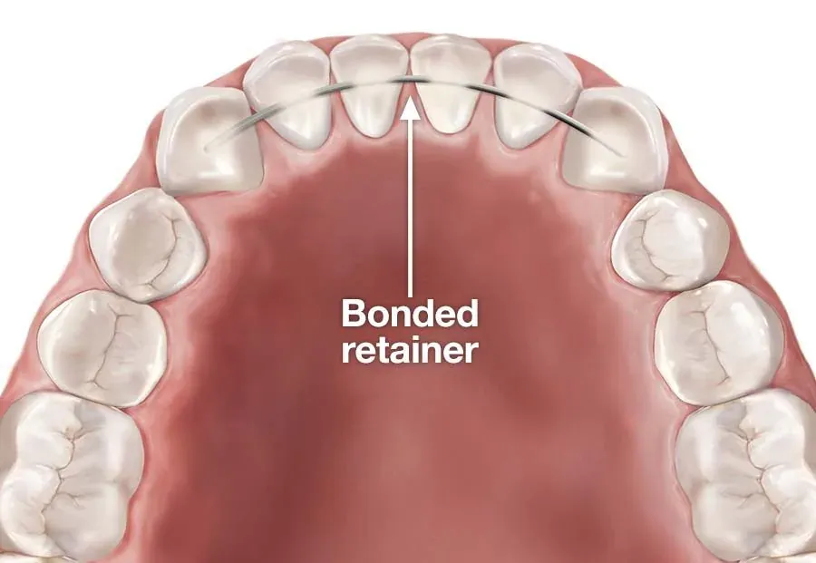 Diagram of a bonded retainer behind the lower front teeth
