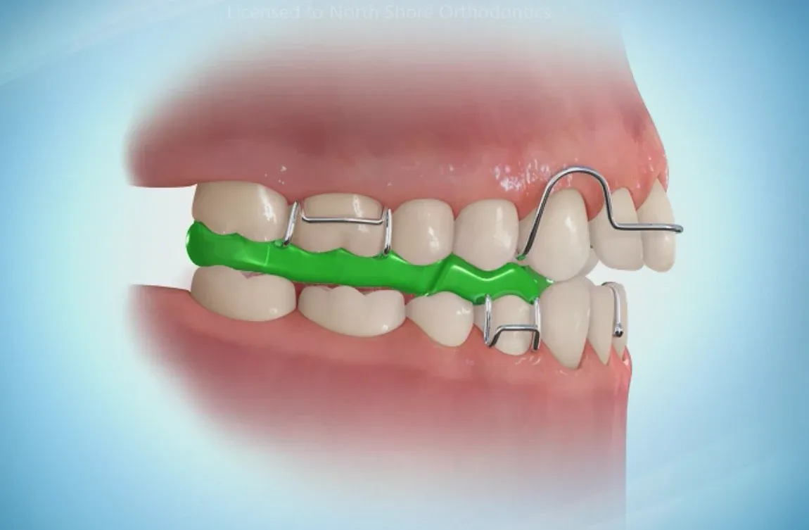 Illustration of a fixed lingual retainer bonded behind the teeth