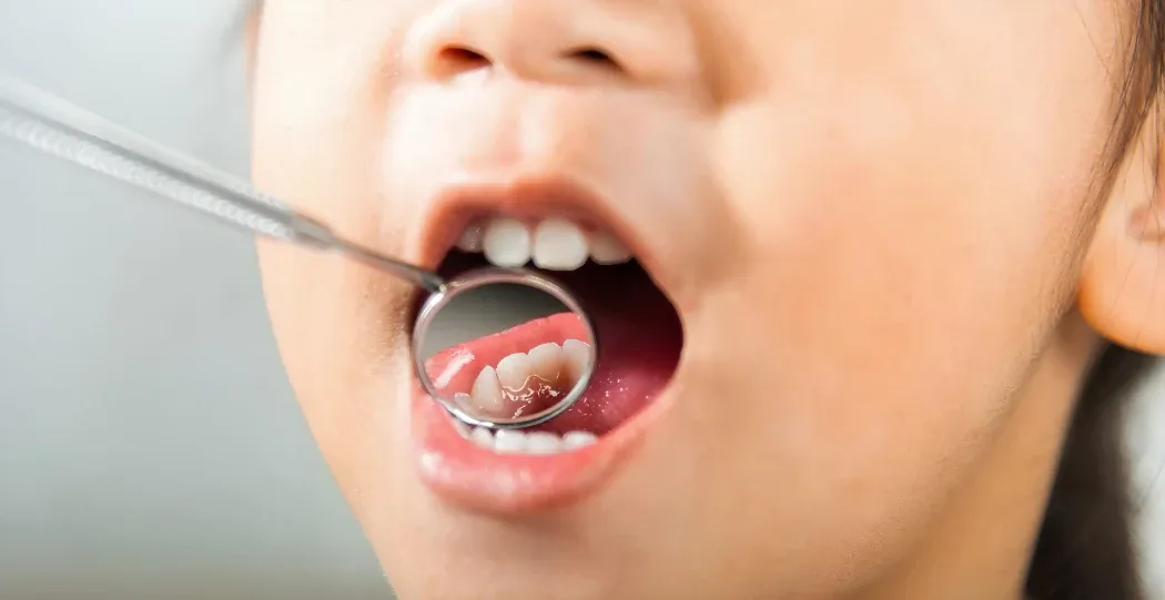 Illustration of fluoride protecting a tooth