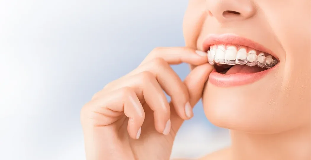 Woman placing a clear Invisalign aligner over her teeth