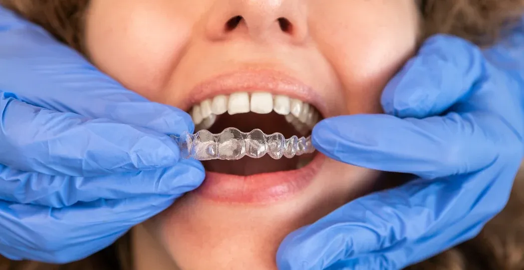 Clinician fitting a clear aligner tray for a patient