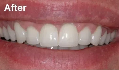 Close-up of a smile after laser gum re-contouring
