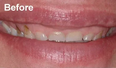 Close-up of a smile before laser gum re-contouring