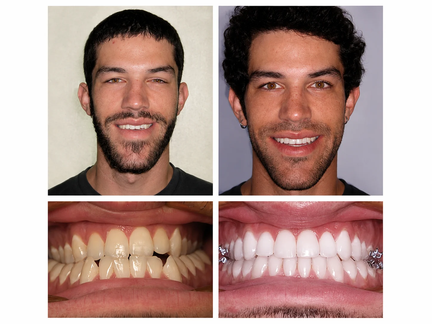 Before and after orthodontic treatment at Bussick Orthodontics in Fort Wayne, patient smile 2