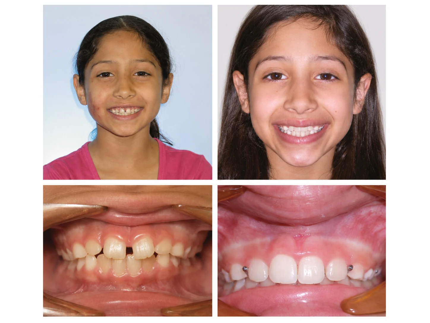 Before and after orthodontic treatment at Bussick Orthodontics in Fort Wayne, patient smile 4