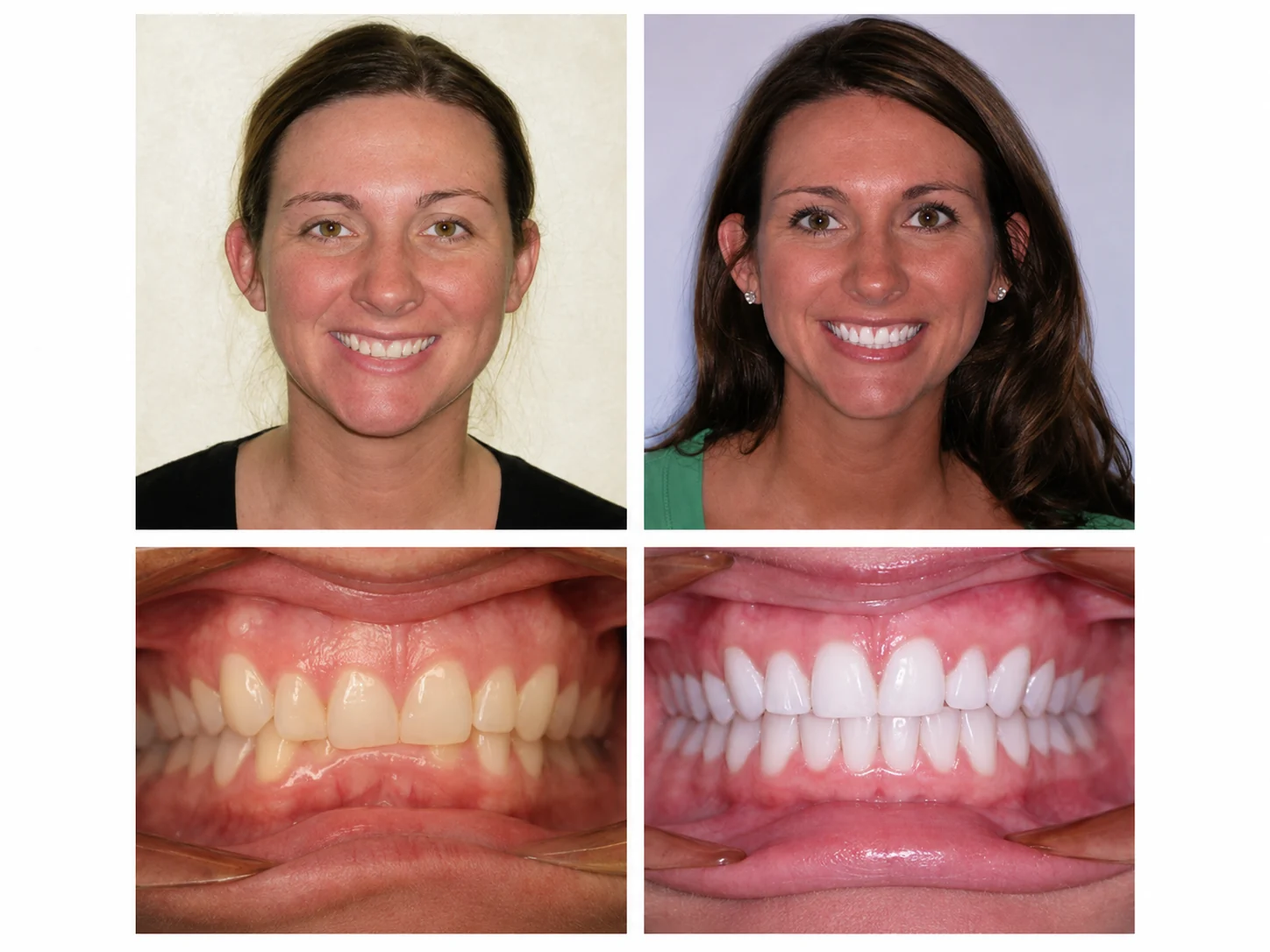 Before and after orthodontic treatment at Bussick Orthodontics in Fort Wayne, patient smile 5